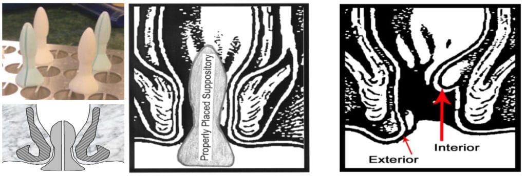 Rectal Rocket Suppositories for Hemorrhoids – Sina Health Centre